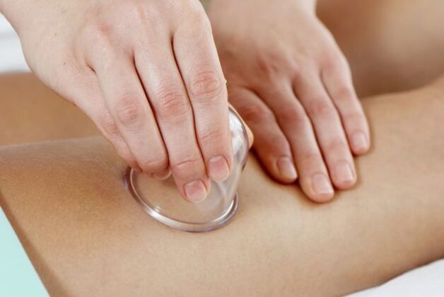 cup massage for varicose veins