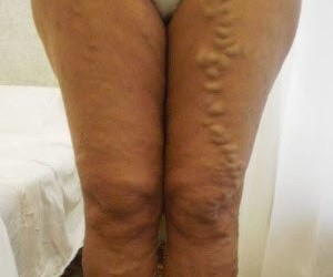 pictures of varicose veins