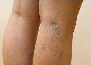 varicose veins on the legs