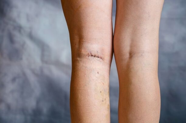 Suture in the leg after surgery for varicose veins
