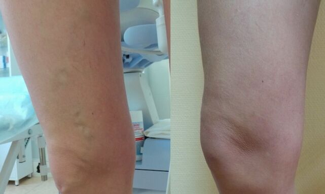 foot before and after treatment of reticular varicose veins