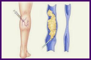 Sclerotherapy is a popular method to get rid of varicose veins in the legs
