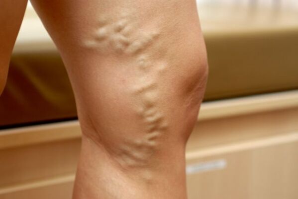 varicose veins in the legs with varicose veins of the lower pelvis