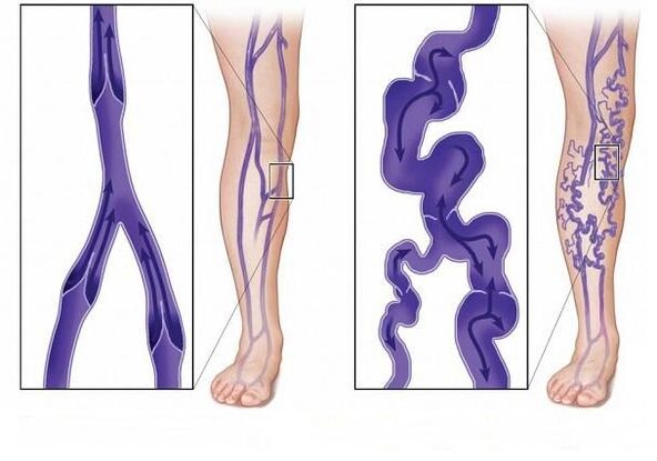 valves with normal vascular valves and varicose veins
