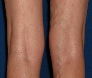 treatment of varicose veins in the legs