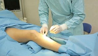How to operate on varicose veins