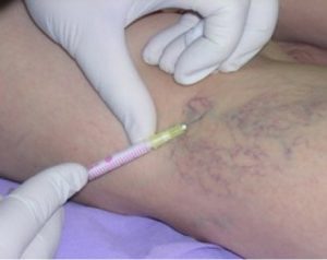 pain varicose veins treatment fluids