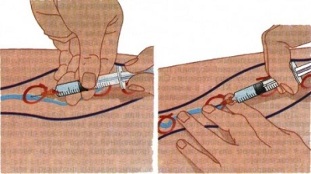 methods of treatment of varicose veins