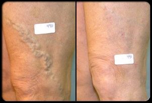 Before and after vascular surgery