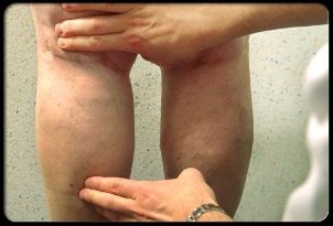 The doctor examines the legs for varicose veins