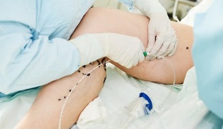 Methods of treatment of varicose veins in the legs in women