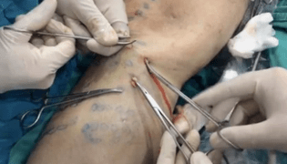 How to do phlebetomy to remove varicose veins
