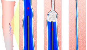 Use of sclerosant during sclerotherapy